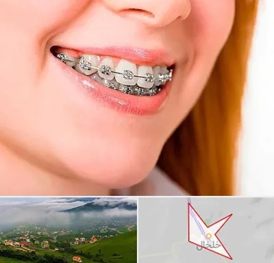 ارتودنسی ارزان در خلخال