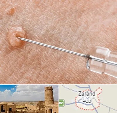 لیزر زگیل تناسلی در زرند
