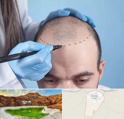 کاشت مو اقساطی در گرمسار