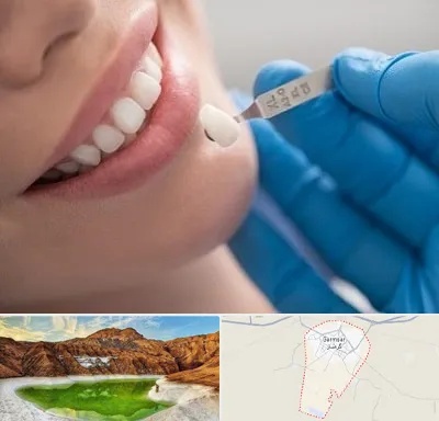 مرکز لمینت دندان در گرمسار