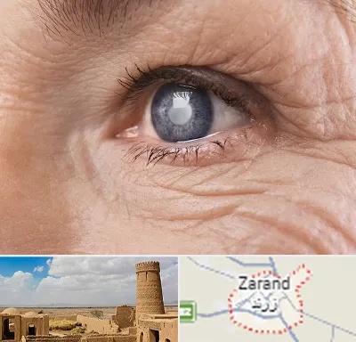 متخصص آب مروارید در زرند