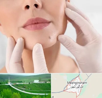 برداشتن خال در مشگین شهر