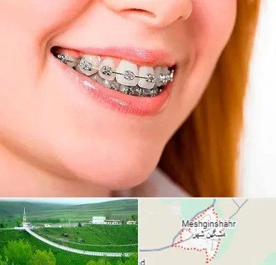ارتودنسی ارزان در مشگین شهر