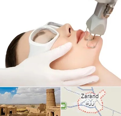 لیزر فرکشنال در زرند
