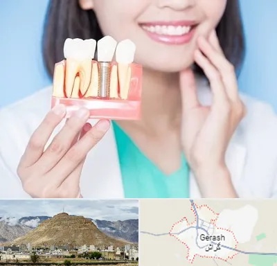 متخصص ایمپلنت در گراش