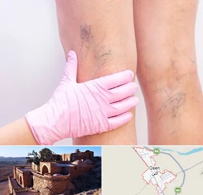 دکتر فوق تخصص واریس در قائن
