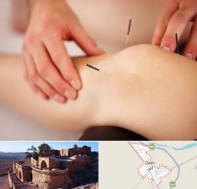دکتر طب سوزنی برای لاغری در قائن
