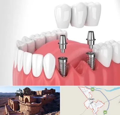 کاشت دندان در قائن