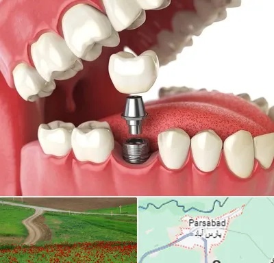 متخصص پروتز دندان در پارس آباد