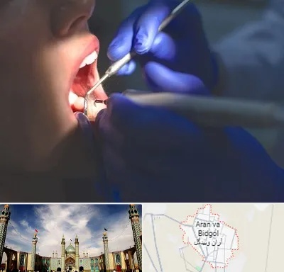 عصب کشی در آران و بیدگل