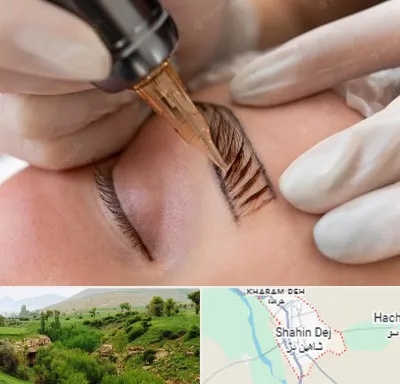 میکروبلیدینگ در شاهین دژ