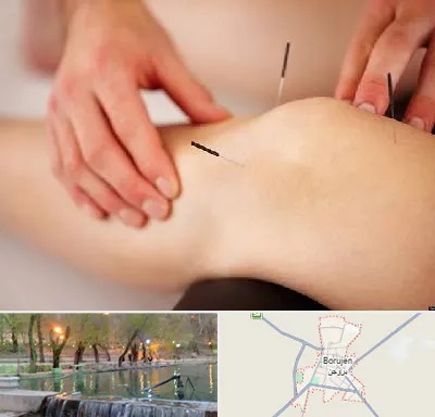 دکتر طب سوزنی برای لاغری در بروجن
