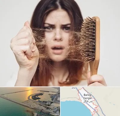 دکتر ریزش مو در بندر کنگان