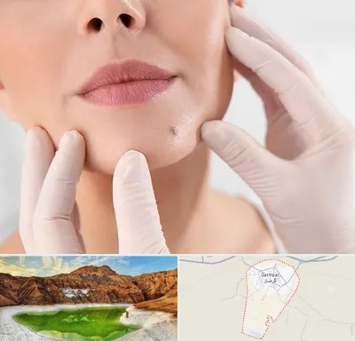 برداشتن خال در گرمسار
