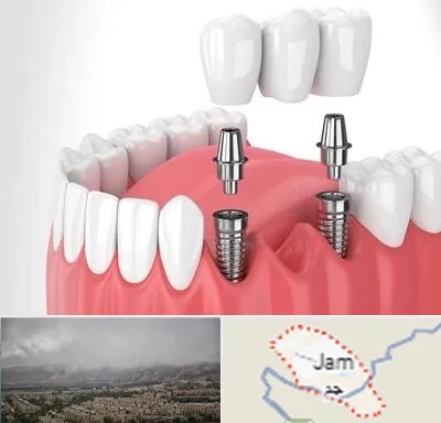 کاشت دندان در جم