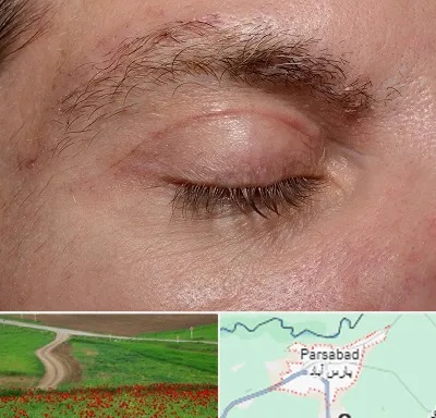 جراح بلفاروپلاستی در پارس آباد