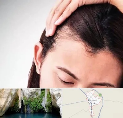 کاشت مو بانوان در خورموج