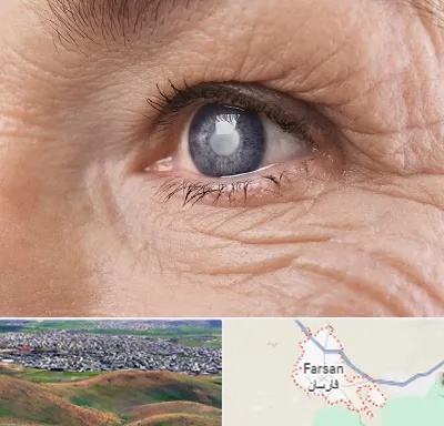 متخصص آب مروارید در فارسان