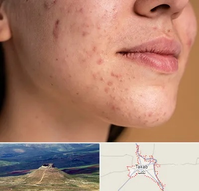 درمان جای جوش در تکاب