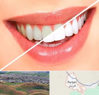 بلیچینگ دندان در فارسان