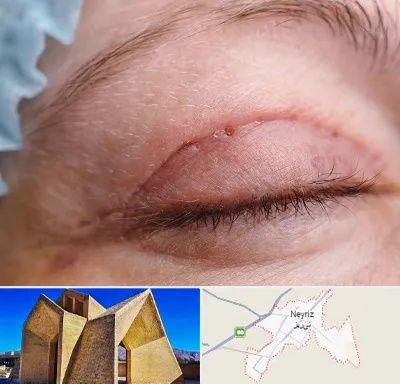 جراح پلک در نی ریز