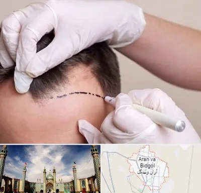 کاشت مو به روش SUT در آران و بیدگل