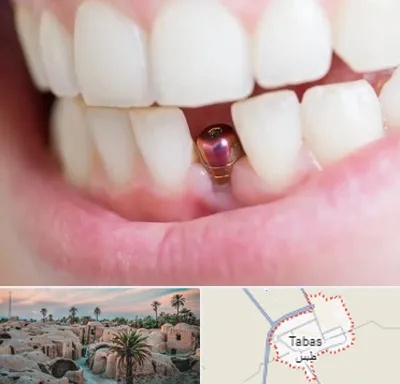 ایمپلنت اقساطی در طبس