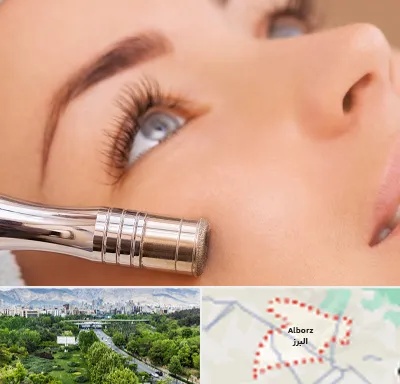 میکرودرم در البرز