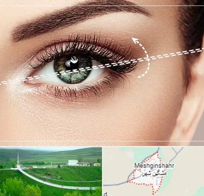 جراحی چشم گربه ای در مشگین شهر