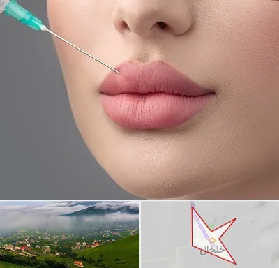 کلینیک ژل لب روسی در خلخال