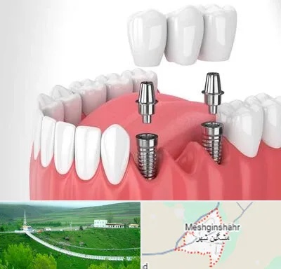 کاشت دندان در مشگین شهر