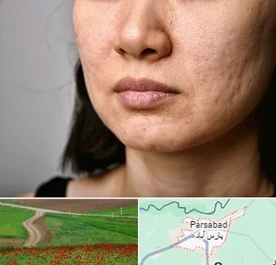سابسیژن جای جوش در پارس آباد