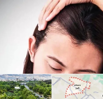 کاشت مو بانوان در البرز