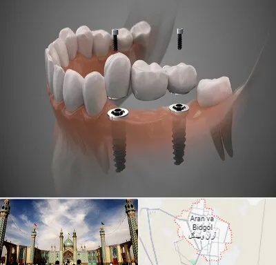 ایمپلنت دیجیتال در آران و بیدگل