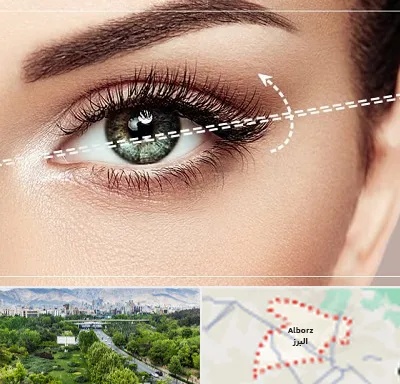 جراحی چشم گربه ای در البرز