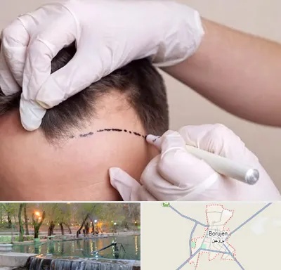 کاشت مو به روش SUT در بروجن