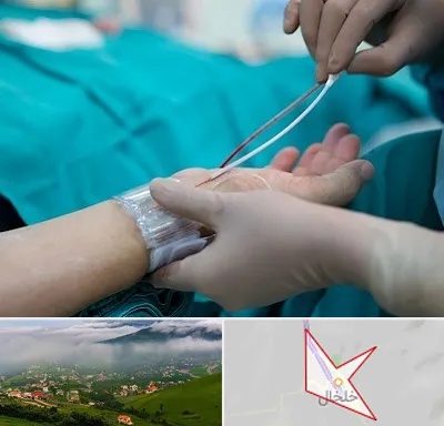 آنژیوگرافی در خلخال