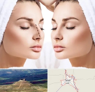 عمل بینی در تکاب
