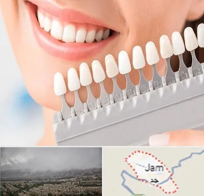 متخصص لمینت دندان در جم