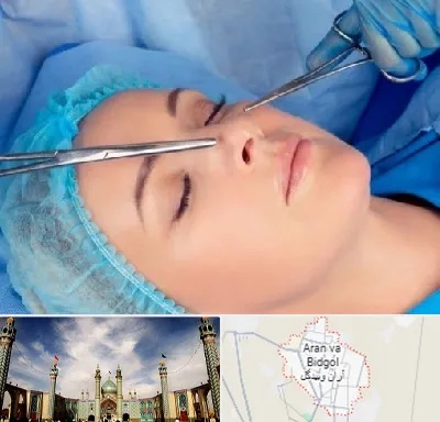 عمل بینی نیمه فانتزی در آران و بیدگل