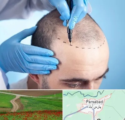 دکتر کاشت مو در پارس آباد