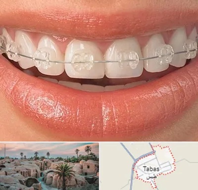 ارتودنسی اقساطی در طبس