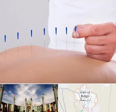 دکتر طب سوزنی در آران و بیدگل