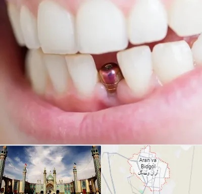ایمپلنت اقساطی در آران و بیدگل