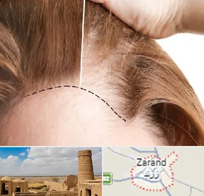 کاشت مو برای خانمها در زرند