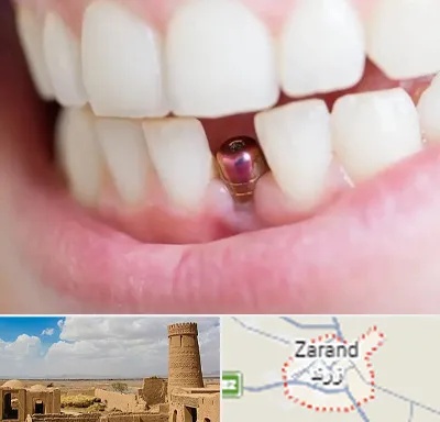 ایمپلنت اقساطی در زرند