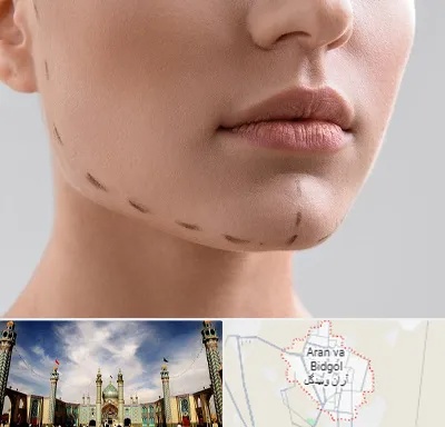 عمل زاویه فک در آران و بیدگل