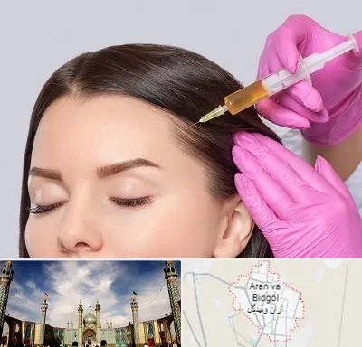 تزریق هیر فیلر در آران و بیدگل