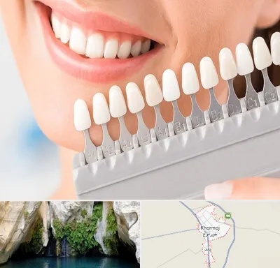 متخصص لمینت دندان در خورموج