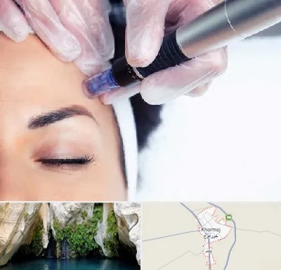 کلینیک مزوتراپی صورت در خورموج